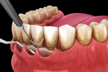 surgical periodontal therapy