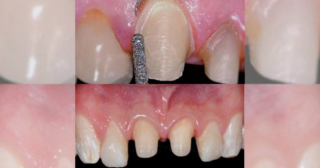 tooth preparation 