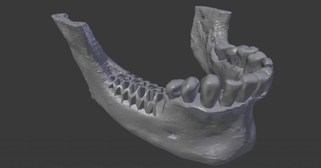 3D printing for bone grafts