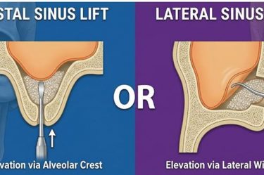crestal vs lateral sinus lift