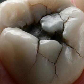 Composite Failures: Causes, Prevention & Clinical Solutions