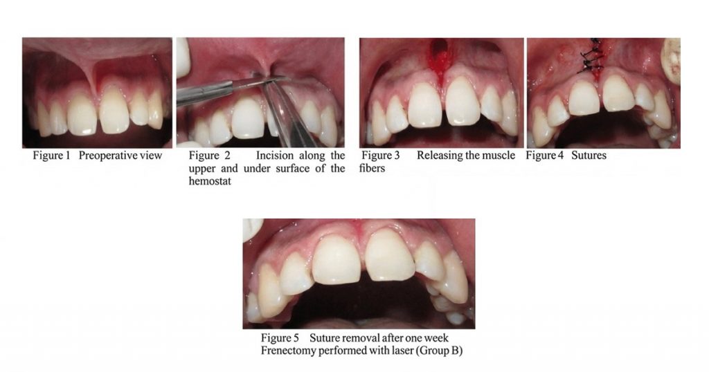 conventional scalpel frenectomy