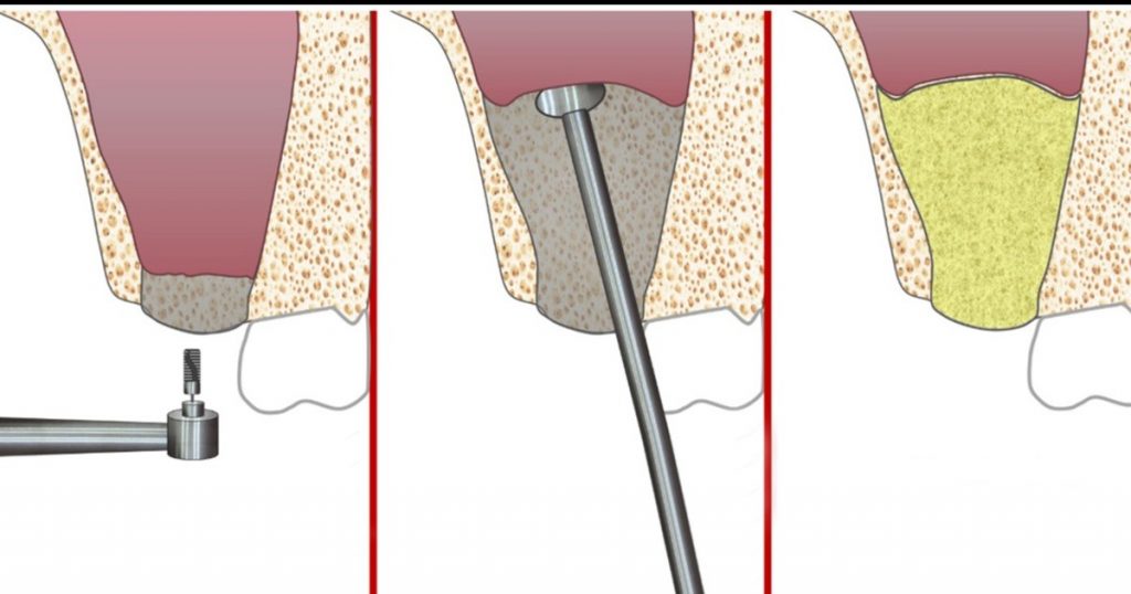crestal sinus innovation