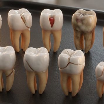 Dental Trauma: Clinical Guide to Ellis Classification & Management
