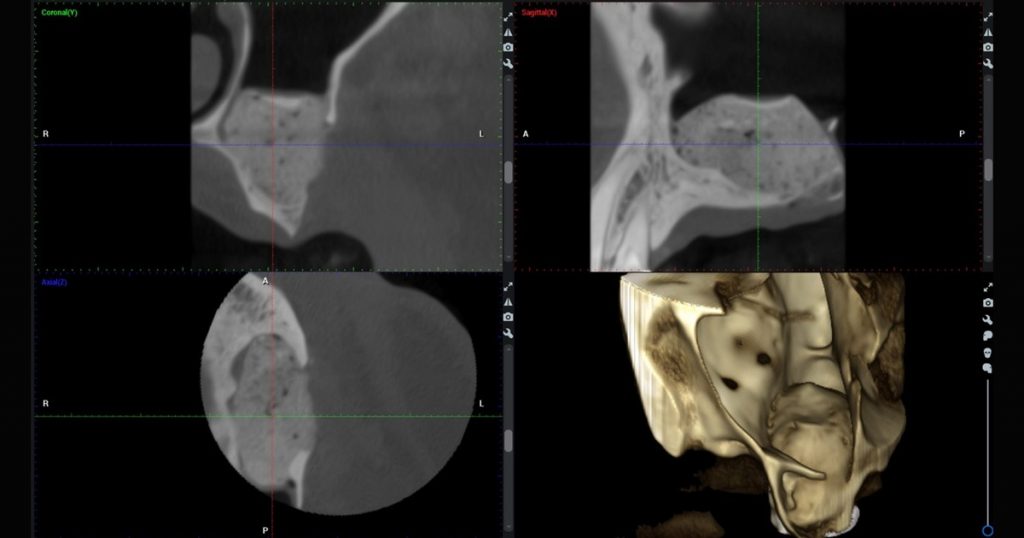 Digitally Planned Lateral Sinus Lifts