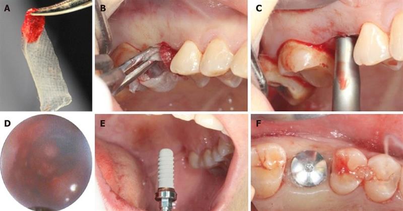 Endoscopic-Assisted Crestal Lift