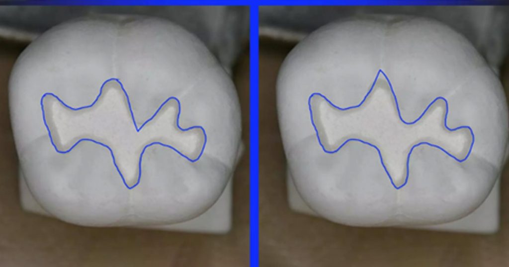 fracture points on teeth