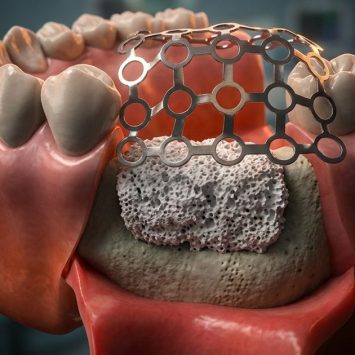 Guided Bone Regeneration (GBR): Steps, Indications & Products