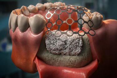 guided bone regeneration