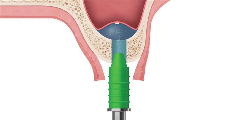 hydraulic sinus elevation