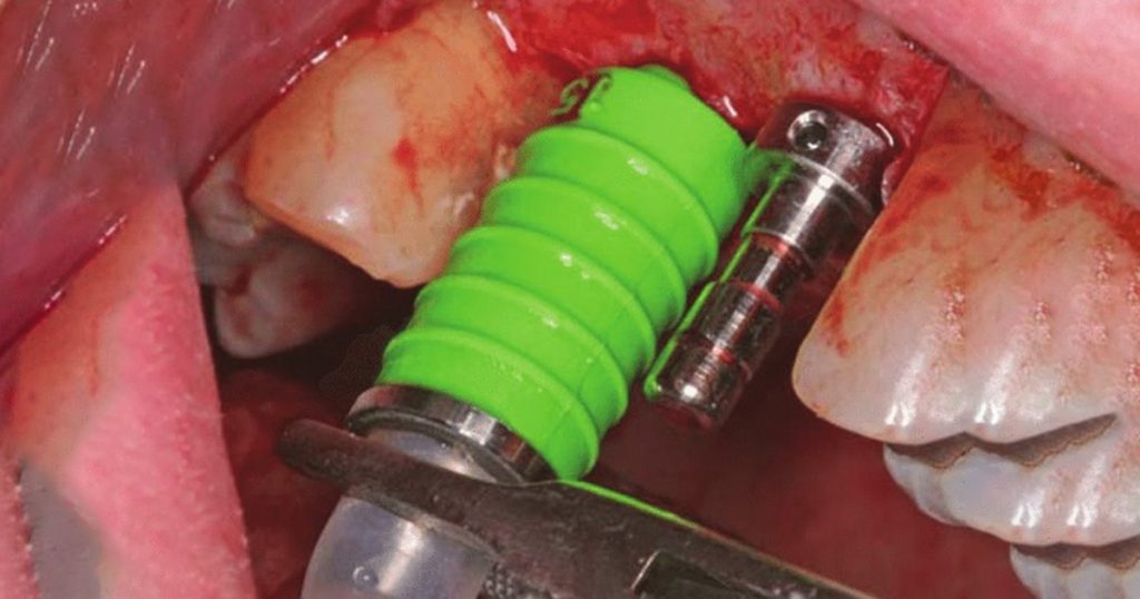 hydraulic sinus lift