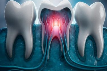 hypersensitive teeth