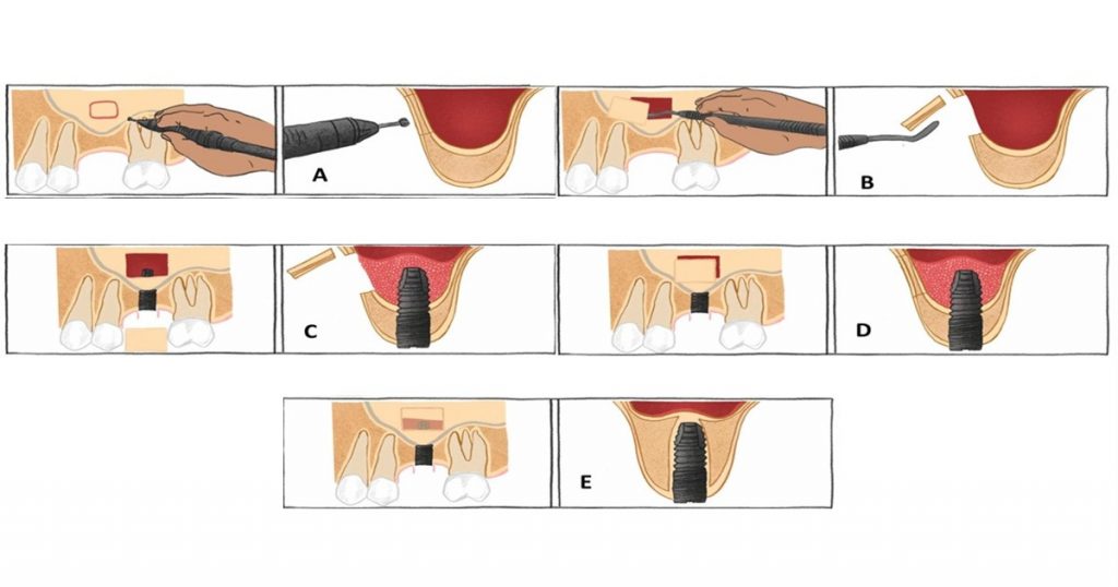 Minimally Invasive Lateral Window Design