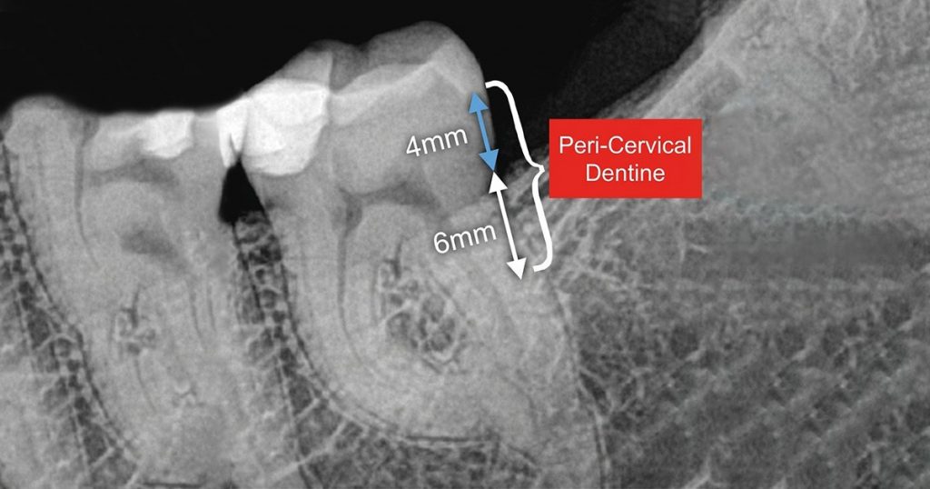 peri-cervical dentine