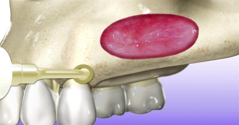 piezoelectric lateral sinus