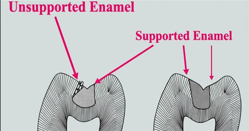 unsupported and supported enamel