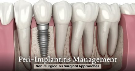 Peri-Implantitis Management: Non-Surgical vs Surgical Approaches