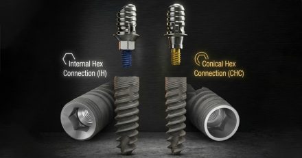Internal Hex vs Conical Implant Connections: A Clinical Guide