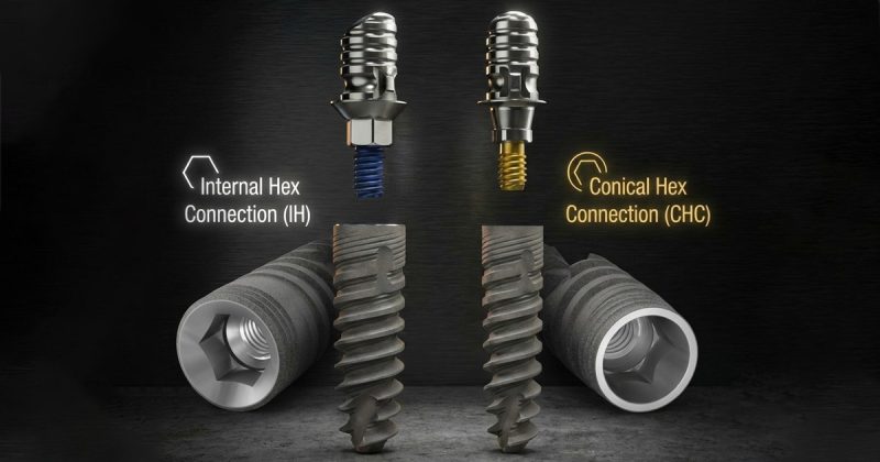 Internal Hex vs Conical Implant Connections: A Clinical Guide