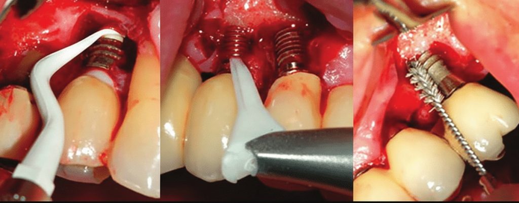 Surgical Management of Peri-Implantitis 